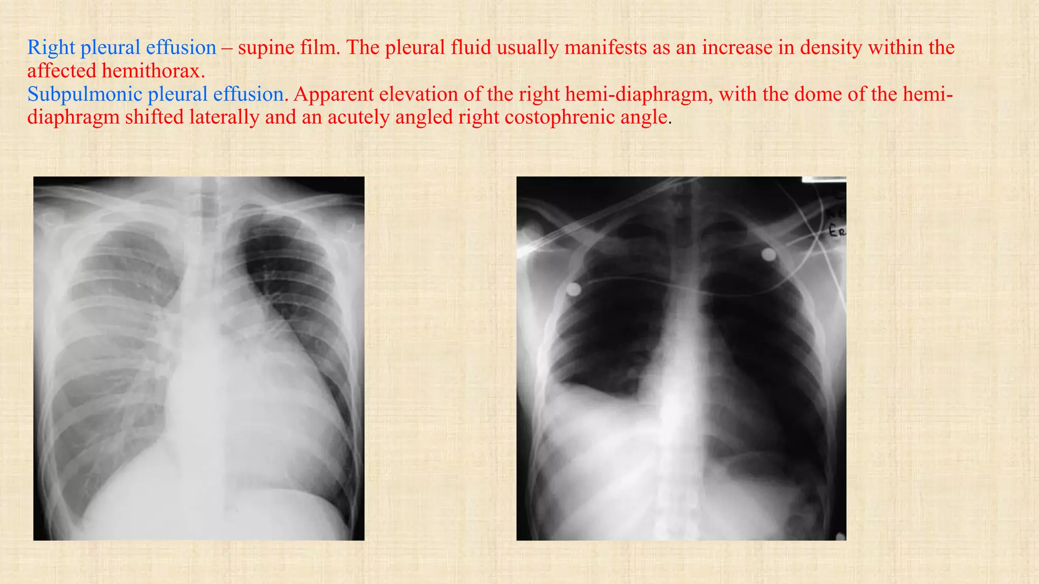 Right pleural effusion – supine film. The pleural fluid usually manifests as an increase in density within the
affected hemithorax.
Subpulmonic pleural effusion. Apparent elevation of the right hemi-diaphragm, with the dome of the hemi-
diaphragm shifted laterally and an acutely angled right costophrenic angle.
 