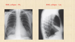 Rml Collapse Radiograph Chest radiology | PDF