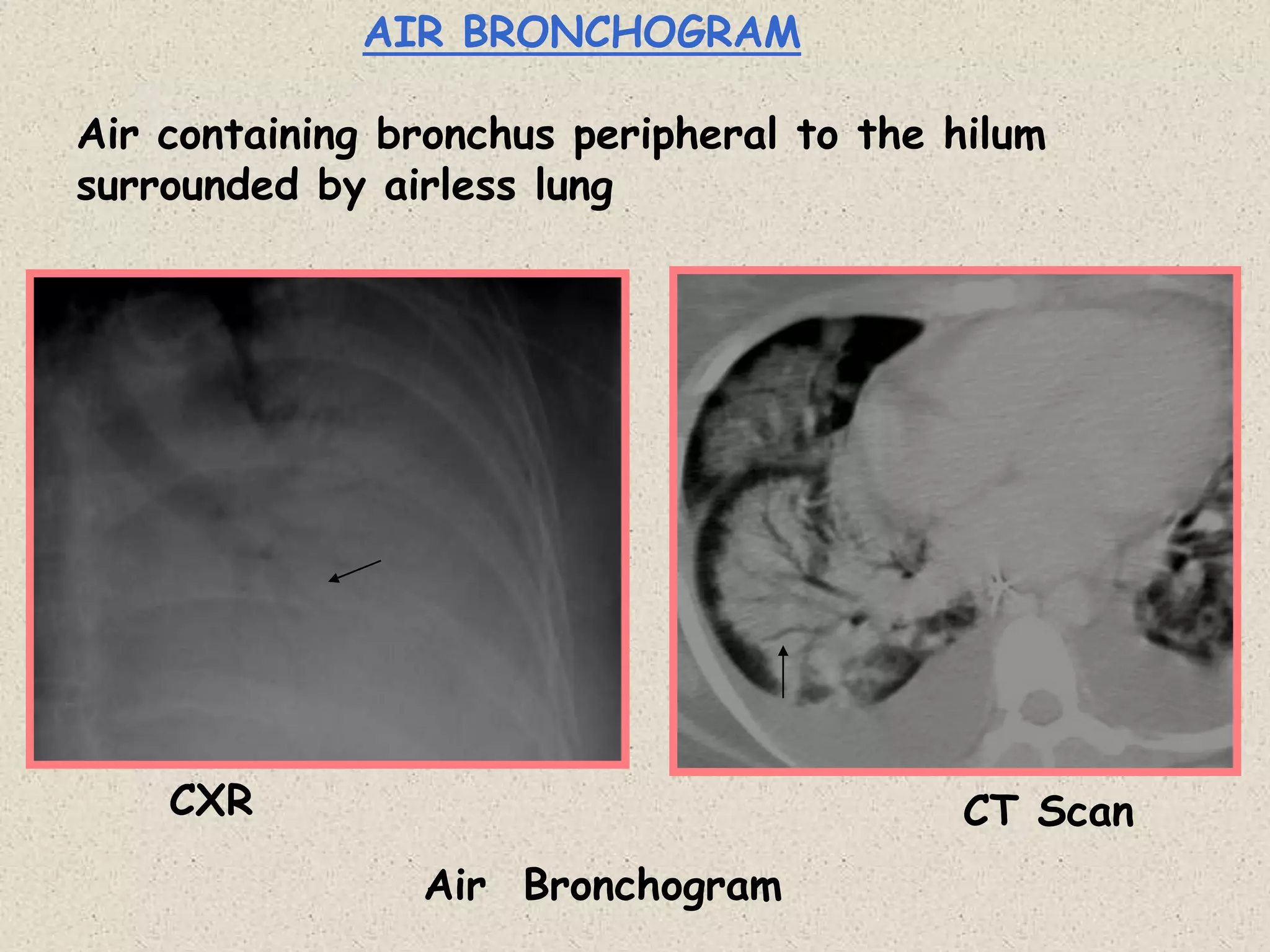 Chest Radiology ppt