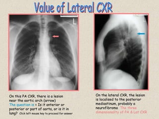On this PA CXR, there is a lesion
near the aortic arch (arrow)
The question is = Is it anterior or
posterior or part of aorta, or is it in
lung? Click left mouse key to proceed for answer
On the lateral CXR, the lesion
is localised to the posterior
mediastinum, probably a
neurofibroma The three
dimensionality of PA & Lat CXR
 