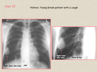 CXR
Close up RLL
Right lower lobe mass
Right lower
lobe mass
History: Young Greek patient with a cough
Case 22
 