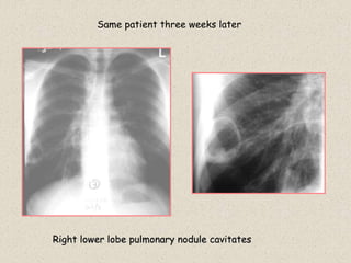 Same patient three weeks later
Right lower lobe pulmonary nodule cavitates
 