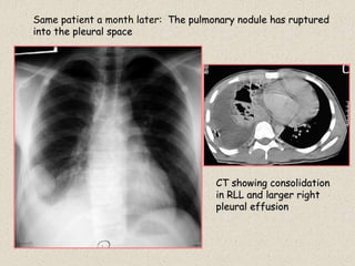 Same patient a month later: The pulmonary nodule has ruptured
into the pleural space
CT showing consolidation
in RLL and larger right
pleural effusion
 
