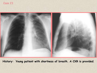 History: Young patient with shortness of breath. A CXR is provided.
Case 23
 