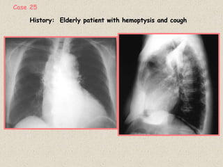 History: Elderly patient with hemoptysis and cough
Case 25
 