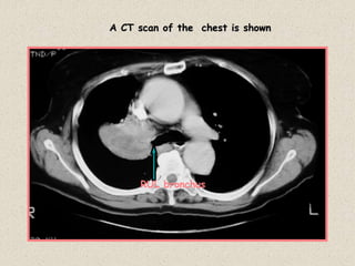 A CT scan of the chest is shown
RUL bronchus
 