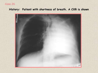 History: Patient with shortness of breath. A CXR is shown
Case 26
 