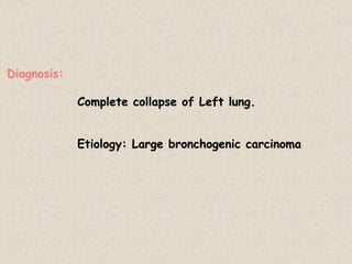 Diagnosis:
Complete collapse of Left lung.
Etiology: Large bronchogenic carcinoma
 