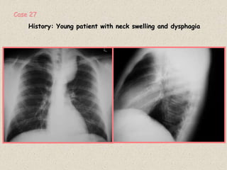 History: Young patient with neck swelling and dysphagia
Case 27
 