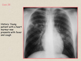 History: Young
patient with a heart
murmur now
presents with fever
and cough
Case 28
 