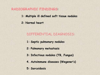 RADIOGRAPHIC FINDINGS:
1: Multiple ill defined soft tissue nodules
2: Normal heart
DIFFERENTIAL DIAGNOSIS:
1: Septic pulmonary nodules
2: Pulmonary metastasis
3: Infectious nodules (TB, Fungus)
4. Autoimmune diseases (Wegener’s)
5: Sarcoidosis
 
