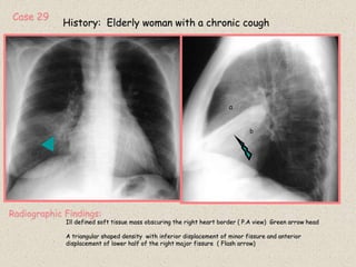 Case 29
History: Elderly woman with a chronic cough
Radiographic Findings:
Ill defined soft tissue mass obscuring the right heart border ( P.A view) Green arrow head
A triangular shaped density with inferior displacement of minor fissure and anterior
displacement of lower half of the right major fissure ( Flash arrow)
a
b
 