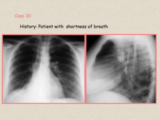 Case 30
History: Patient with shortness of breath
 