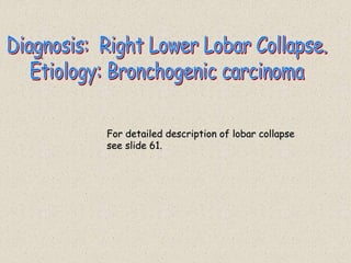 .
For detailed description of lobar collapse
see slide 61.
 
