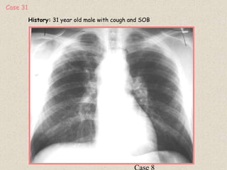History: 31 year old male with cough and SOB
Case 31
 