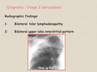 Diagnosis : Stage 2 sarcoidosis
Radiographic findings:
1: Bilateral hilar lymphadenopathy
2: Bilateral upper lobe interstitial pattern
Close up RUL
 