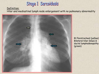 Rt Paratracheal (yellow)
Bilateral hilar (blue) &
ductal lymphadenopathy
(green)
Definition:
Hilar and mediastinal lymph node enlargement with no pulmonary abnormality
 