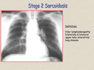 Definition:
Hilar lymphadenopathy
bilaterally & bilateral
upper lobe interstitial
lung disease
 