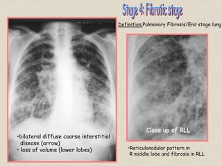 Close up of RLL
•bilateral diffuse coarse interstitial
disease (arrow)
• loss of volume (lower lobes) •Reticulonodular pattern in
R middle lobe and fibrosis in RLL
Definition:Pulmonary Fibrosis/End stage lung
 