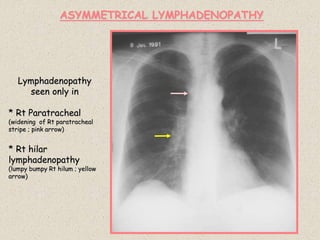 Lymphadenopathy
seen only in
* Rt Paratracheal
(widening of Rt paratracheal
stripe ; pink arrow)
* Rt hilar
lymphadenopathy
(lumpy bumpy Rt hilum ; yellow
arrow)
ASYMMETRICAL LYMPHADENOPATHY
 