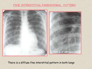 Close up of right upper lobe
FINE INTERSTITIAL PARENCHYMAL PATTERN
There is a diffuse fine interstitial pattern in both lungs
 