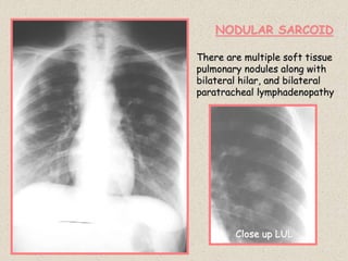 NODULAR SARCOID
There are multiple soft tissue
pulmonary nodules along with
bilateral hilar, and bilateral
paratracheal lymphadenopathy
Close up LUL
 