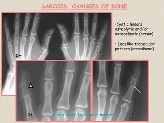 SARCOID CHANGES OF BONE
Rt
Lt
Rt Lt
Close up of the bone changes
•Cystic leisons
osteolytic and/or
osteoclastic (arrow)
• Lacelike trabecular
pattern (arrowhead)
 
