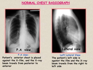 NORMAL CHEST RADIOGRAPH
P.A view Lateral view
P.A view:
Patient’s anterior chest is placed
against the X-film, and the X-ray
beam travels from posterior to
anterior
Left Lateral View:
The patient’s left side is
against the film and the X-ray
beam travels from the right to
left side
 