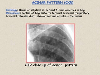 ACINAR PATTERN (CXR)
Radiology: Round or elliptical ill-defined 4-8mm opacities in lung
Microscopic: Portion of lung distal to terminal bronchial (respiratory
bronchial, alveolar duct, alveolar sac and alveoli) is the acinus
CXR close up of acinar pattern
 