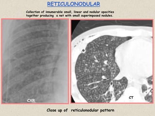 RETICULONODULAR
Collection of innumerable small, linear and nodular opacities
together producing a net with small superimposed nodules.
Close up of reticulonodular pattern
CXR
CT
 