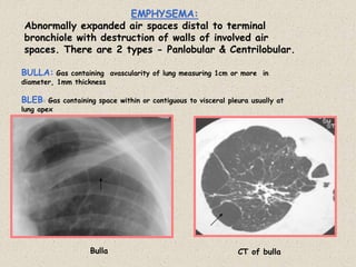 BULLA: Gas containing avascularity of lung measuring 1cm or more in
diameter, 1mm thickness
BLEB: Gas containing space within or contiguous to visceral pleura usually at
lung apex
EMPHYSEMA:
Abnormally expanded air spaces distal to terminal
bronchiole with destruction of walls of involved air
spaces. There are 2 types - Panlobular & Centrilobular.
Bulla CT of bulla
 