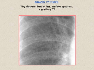 MILIARY PATTERN:
Tiny discrete 2mm or less, uniform opacities,
e.g miliary TB
 