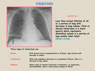 ATELECTASIS
Three types of atelectasis are
Passive: With process such as pneumothorax or effusion, lung retracts with
decrease in volume.
Cicatrization: When lung compliance decreases as in pulmonary fibrosis, there is a
decrease in lung volume
Adhesive: When action of alveolar surfactant is disturbed, e.g respiratory
distress(ARDS), there is wide spread collapse of alveoli
Definition:
Less than normal inflation of all
or a portion of lung with
decrease in lung volume. Plate or
discoid atelectasis is a linear
opacity which represents
diminished volume in a portion of
lung usually lower lobes
(Green arrow)
 