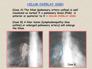 HILUM OVERLAY SIGN
(Case A) The hilum (pulmonary artery-yellow) is well
visualized as normal if a pulmonary lesion (Pink) is
anterior or posterior to it = HILUM OVERLAY SIGN
(Case B) A hilar lesion (lymphadenopathy-blue
outline) or enlarged pulmonary artery) will enlarge
the hilum
Case A Case B
 