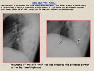 SILHOUETTE SIGN:
The effacement of an anatomic soft tissue border within the thorax by a process of equal or similar density
in contiguous lung or pleural; e.g pneumonia in medial segment of right middle lobe will silhouette the right
heart border, lingula the left heart border, and the lower lobes silhouette the hemidiaphragm
Pneumonia of the left lower lobe has obscured the posterior portion
of the left hemidiaphragm
Rt
Lt
 