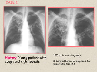 History: Young patient with
cough and night sweats
1:What is your diagnosis
2: Give differential diagnosis for
upper lobe fibrosis
CASE 1
 