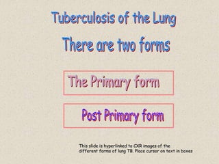This slide is hyperlinked to CXR images of the
different forms of lung TB. Place cursor on text in boxes
 