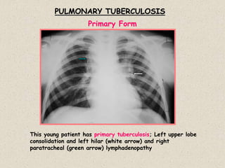 PULMONARY TUBERCULOSIS
This young patient has primary tuberculosis; Left upper lobe
consolidation and left hilar (white arrow) and right
paratracheal (green arrow) lymphadenopathy
Primary Form
 