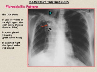 PULMONARY TUBERCULOSIS
The CXR shows
1: Loss of volume of
the right upper lobe
(open arrow showing
displaced hilum)
2: Apical pleural
thickening
(green arrow head)
3: Calcified right
hilar lymph nodes
(red arrow)
Fibrocalcific Pattern
 