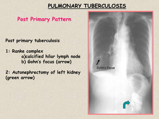PULMONARY TUBERCULOSIS
Post primary tuberculosis
1: Ranke complex
a)calcified hilar lymph node
b) Gohn’s focus (arrow)
2: Autonephrectomy of left kidney
(green arrow)
Post Primary Pattern
Gohn’s focus
 