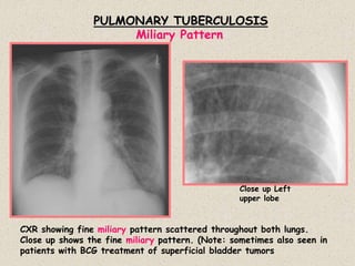 PULMONARY TUBERCULOSIS
CXR showing fine miliary pattern scattered throughout both lungs.
Close up shows the fine miliary pattern. (Note: sometimes also seen in
patients with BCG treatment of superficial bladder tumors
Close up Left
upper lobe
Miliary Pattern
 