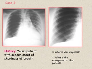 History: Young patient
with sudden onset of
shortness of breath
1: What is your diagnosis?
2: What is the
management of this
patient?
Case 2
 