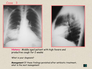 Case 3
History: Middle aged patient with high fevers and
productive cough for 2 weeks
What is your diagnosis?
Management:If these findings persisted after antibiotic treatment,
what is the next management
 