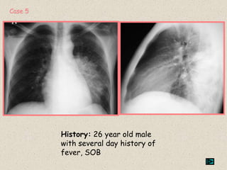 History: 26 year old male
with several day history of
fever, SOB
Case 5
 