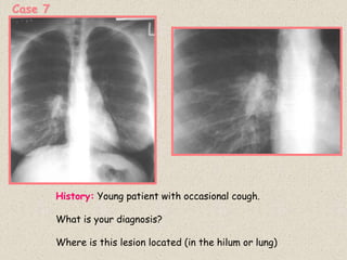 Case 7
History: Young patient with occasional cough.
What is your diagnosis?
Where is this lesion located (in the hilum or lung)
 