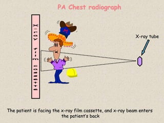 PA Chest radiograph
X-ray tube
The patient is facing the x-ray film cassette, and x-ray beam enters
the patient’s back
 