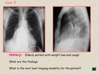 Case 9
History: Elderly patient with weight loss and cough.
What are the findings.
What is the next best imaging modality for the patient?
 