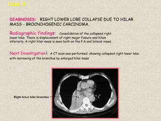 Case 9
Radiographic findings: Consolidation of the collapsed right
lower lobe. There is displacement of right major fissure and hilum
inferiorly. A right hilar mass is seen both on the P.A and lateral views.
DIAGNOSIS: RIGHT LOWER LOBE COLLAPSE DUE TO HILAR
MASS - BROCNCHOGENIC CARCINOMA.
Next Investigation: A CT scan was performed showing collapsed right lower lobe
with narrowing of the bronchus by enlarged hilar mass
Right lower lobe bronchus
 