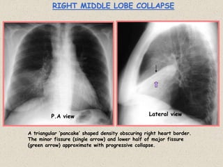 RIGHT MIDDLE LOBE COLLAPSE
A triangular ‘pancake’ shaped density obscuring right heart border.
The minor fissure (single arrow) and lower half of major fissure
(green arrow) approximate with progressive collapse.
P.A view Lateral view
 