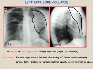 LEFT UPPR LOBE COLLAPSE
The Lingula and Left upper lobe collapse together (single LUL bronchus)
Lateral CXR: Distinctive ‘pancake’(outline) opacity in retrosternal air space.
CXR Findings: PA view large opacity (outline) silhouetting left heart border (arrows).
P.A Lateral
 